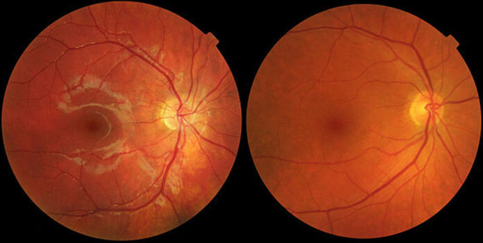 Scientists at The University of Manchester have taken an important step towards finding a treatment for age-related macular degeneration
