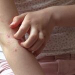 A biologic therapy for very young children with a moderate to severe form of eczema condition has been shown to be safe and effective